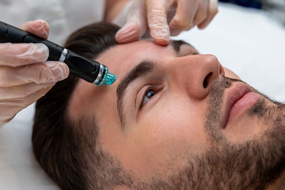 rf microneedling rf microneedling