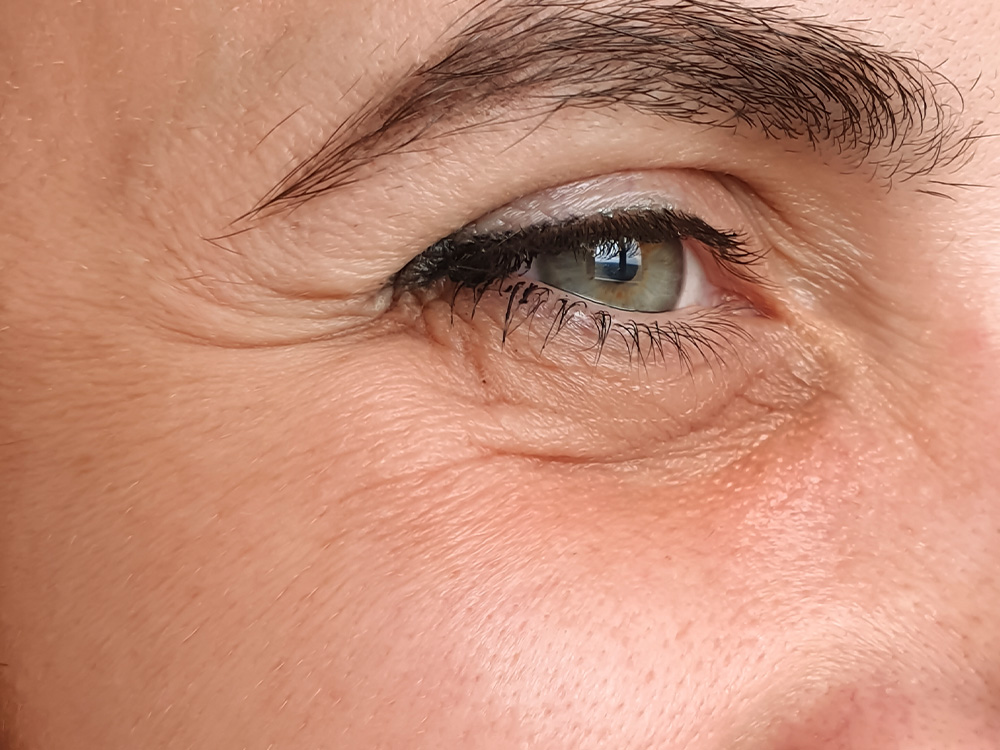 Botox Around Eyes - Before