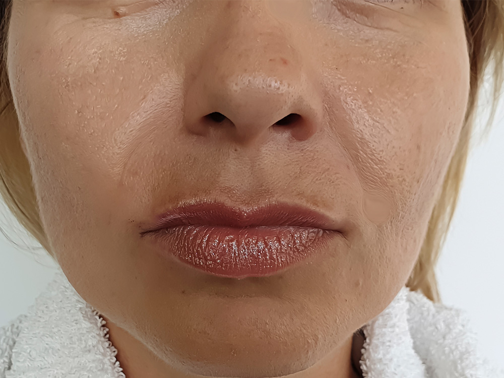 Botox for Masseters - Before