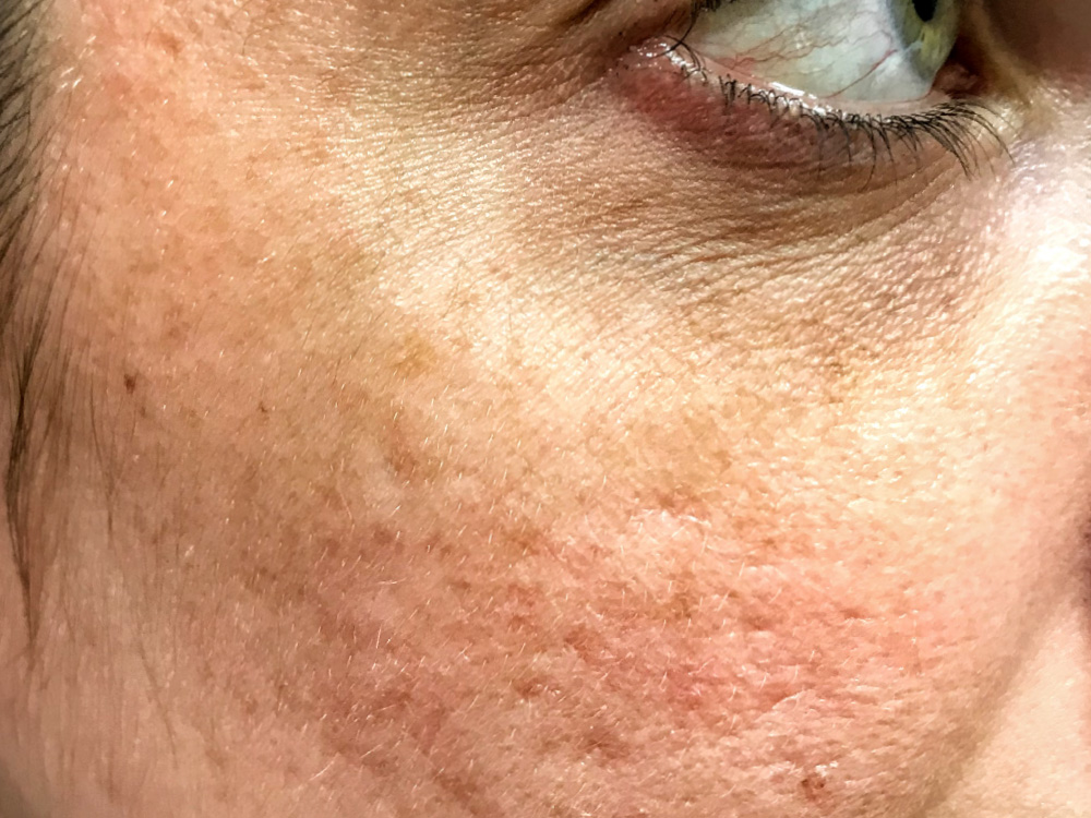 before halo treatment