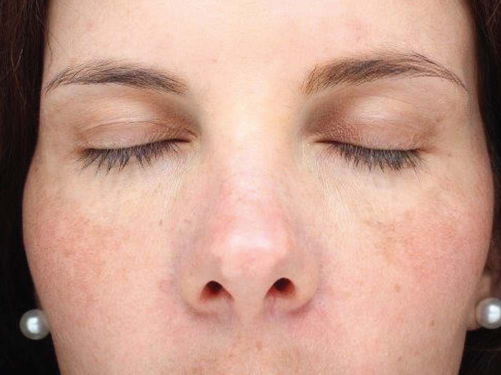 halo laser before photo